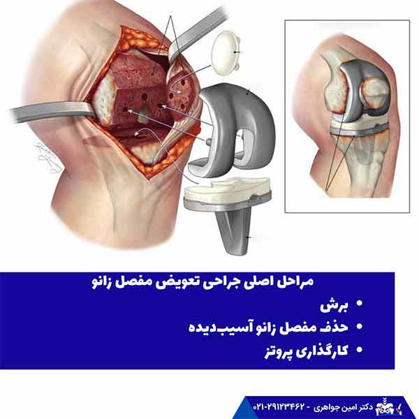 مراحل اصلی جراحی تعویض مفصل زانو