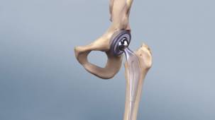 انواع عمل تعویض مفصل ران - راهنمای کامل و تخصصی تعویض مفصل لگن