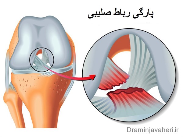 پارگی رباط صلیبی