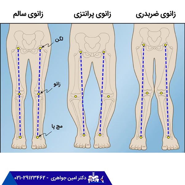 پای پرانتزی