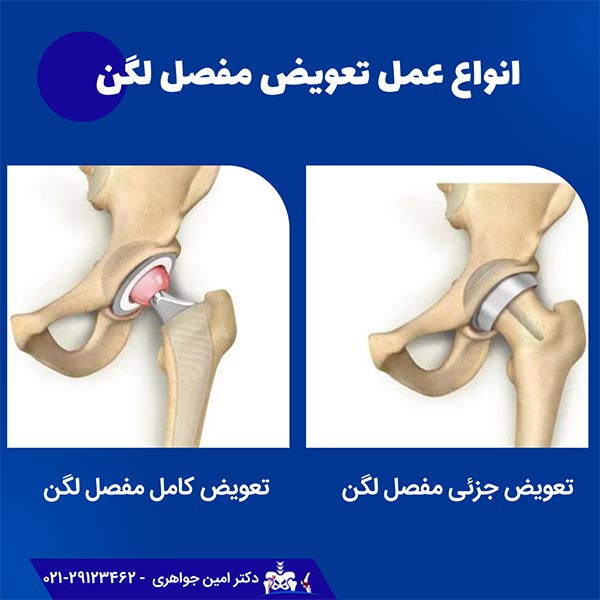 دو نوع عمل آرتروپلاستی لگن