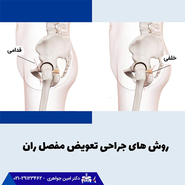 محل برش جراحی تعویض مفصل لگن