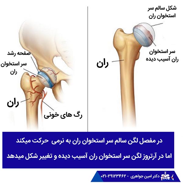 تشخیص آرتروز لگن
