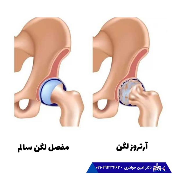 آرتروز لگن