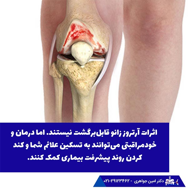 اثرات آرتروز