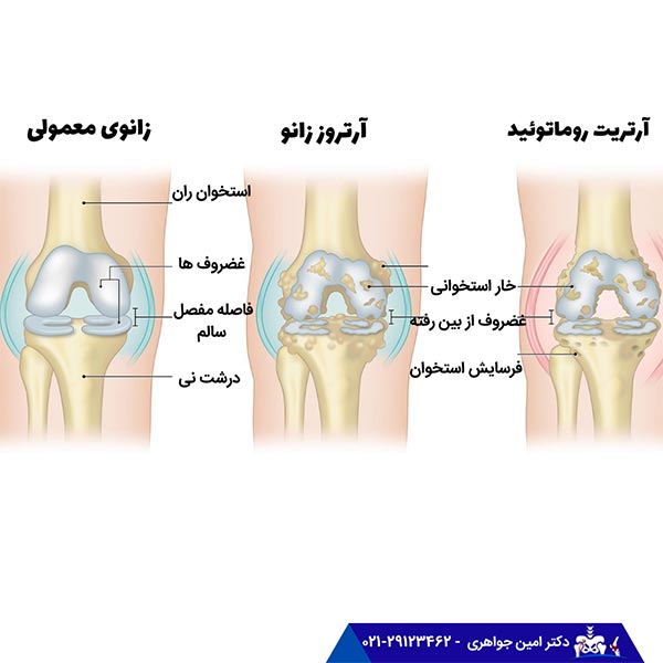 آرتروز زانو چگونه تشخیص داده میشود؟