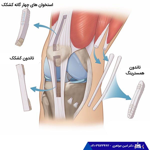 زمان مناسب برای انجام جراحی پارگی رباط صلیبی قدامی (ACL )