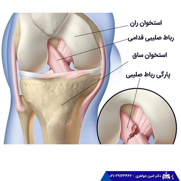 آسیب و پارگی ربا صلیبی قدامی