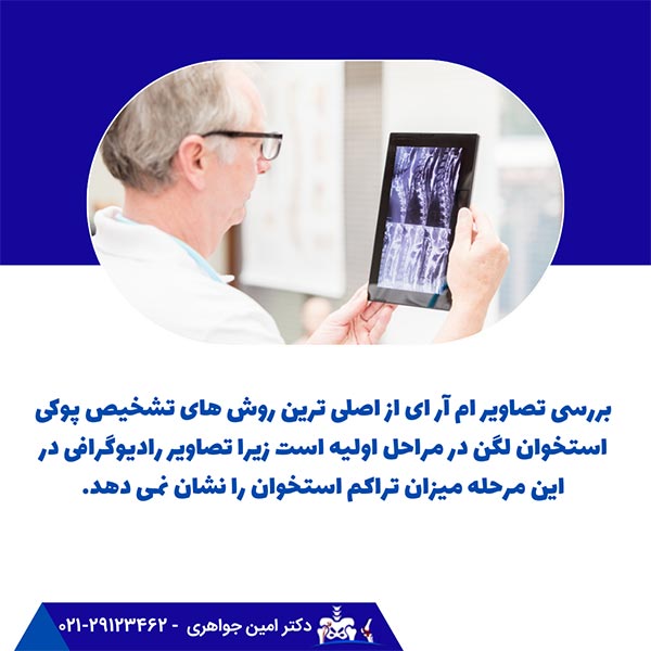 تشخیص پوکی استخوان با بررسی تصاویر رادیوگرافی