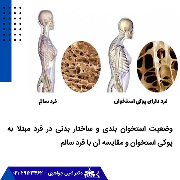 وضعیت استخوان بندی و ساختار بدنی در فرد مبتلا به پوکی استخوان و مقایسه آن با فرد سالم