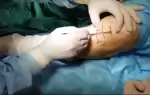 جراحی پای پرانتزی 1