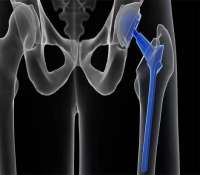 آرتروپلاستی مفصل ران یا هیپ برای چه بیمارانی انجام می‌شود؟