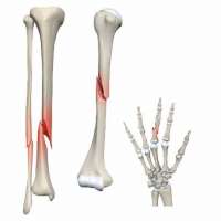 جوش نخوردن شکستگی استخوان - علت، عوارض و نحوه درمان