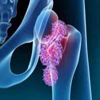 تومور های استخوانی - علائم، تشخیص و درمان