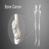 سرطان استخوان چیست؟ انواع سرطان استخوان، تشخیص و درمان