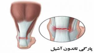 روش های درمان پارگی تاندون آشیل پا