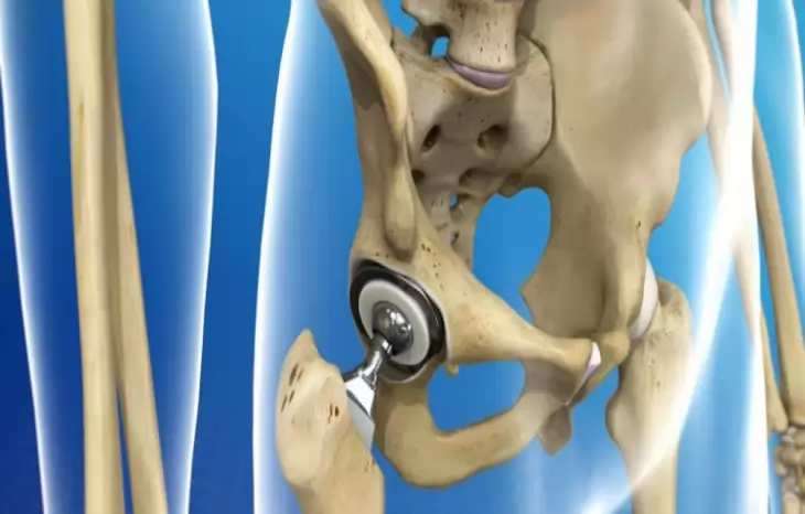 بعد از تعویض مفصل لگن چه محدودیت هایی برای بیمار ایجاد می شود؟