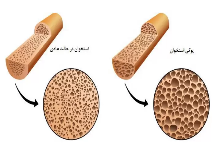 پوکی استخوان زودرس | دلایل، راه های تشخیص و پیشگیری از آن
