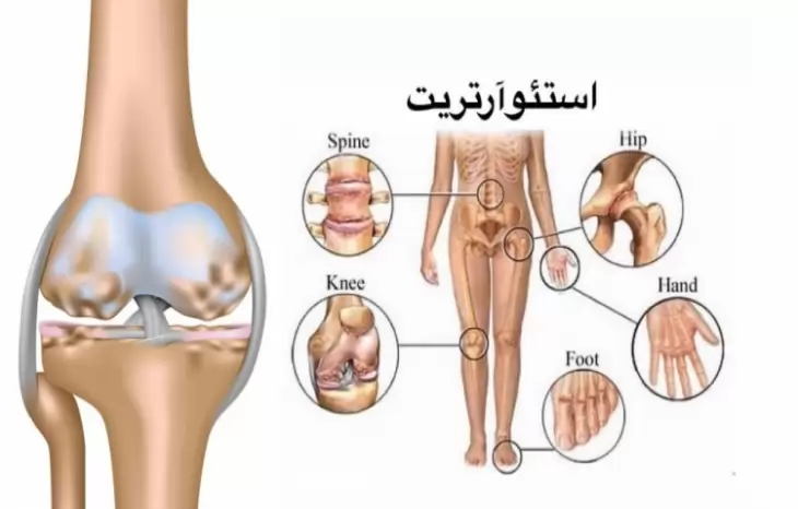 آشنایی با علائم، راه های تشخیص و درمان بیماری استئوآرتریت