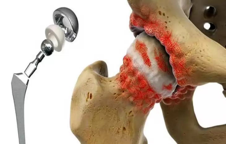 چه افرادی برای تعویض کامل مفصل لگن مناسب هستند؟