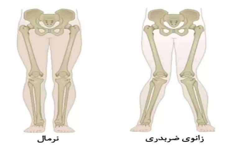 اصلاح زانوی ضربدری بدون جراحی