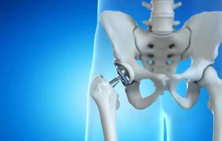 مشکلات و عوارض بعد از جراحی تعویض مفصل لگن