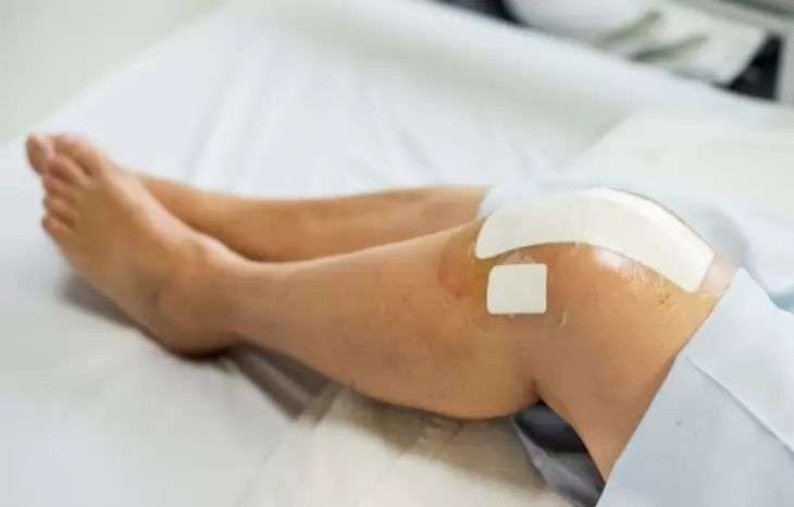 دوره نقاهت عمل تعویض مفصل زانو چقدر طول می کشد؟