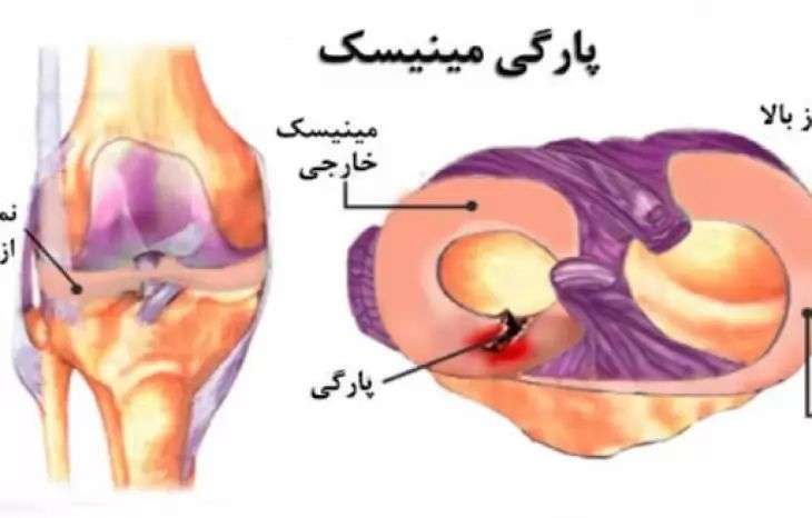 پارگی مینیسک زانو، علائم، علت و راه های درمان آن