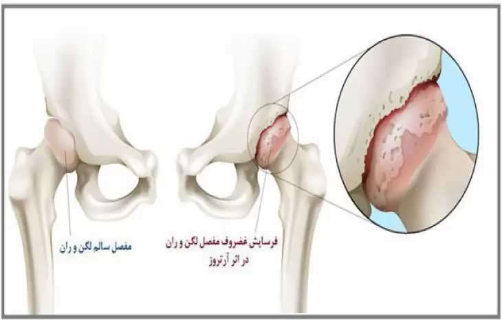 آرتروز لگن