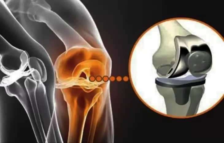 هزینه تعویض مفصل زانو چقدر است؟
