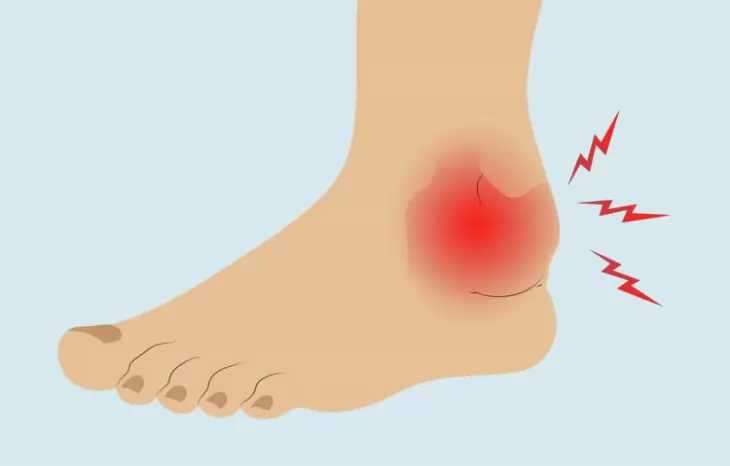 برای درمان شکستگی مچ پا چه باید کرد؟