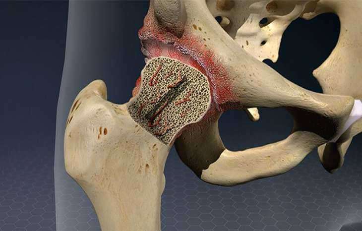 آشنایی کامل با نکروز آواسکولار (AVN) یا نکروز استخوان
