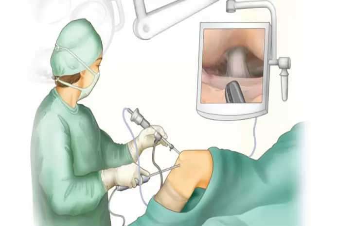 جراحی آرتروسکوپی زانو چیست؟ و چگونه انجام می شود؟