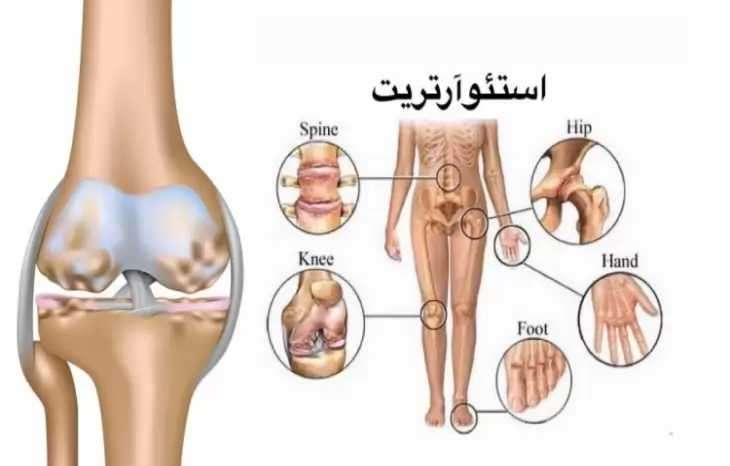 آشنایی با علائم، راه های تشخیص و درمان بیماری استئوآرتریت