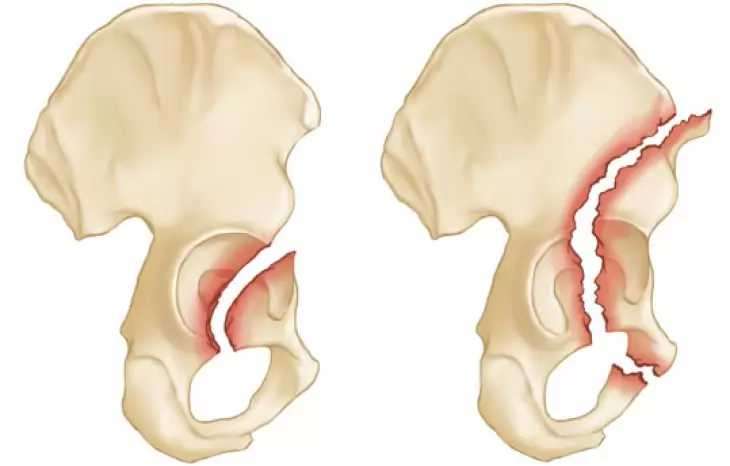 شکستگی استابولوم لگن چیست و چه عوارضی دارد؟