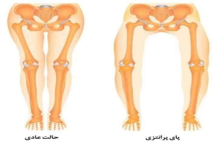 برای اصلاح و درمان پای پرانتزی چکار باید بکنیم؟